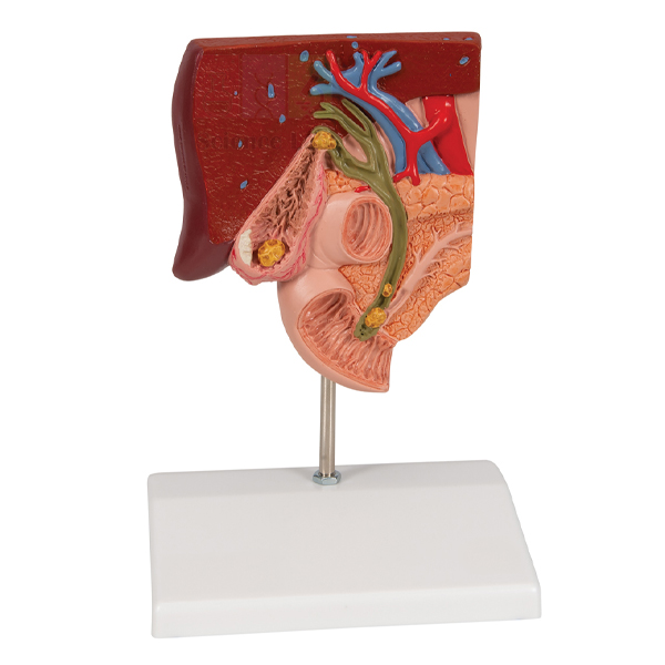 Gallstone Model